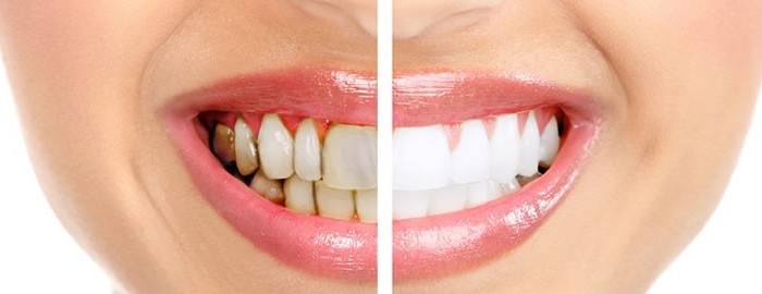 Diş Eti İltihabının Üç Nedenini Öğrenin Dentistiklal Ataköy